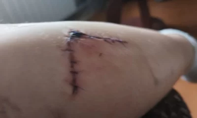 &laquo;Глубокая рана&raquo;: под Ярославлем хозяйская собака вцепилась в ногу ребенку