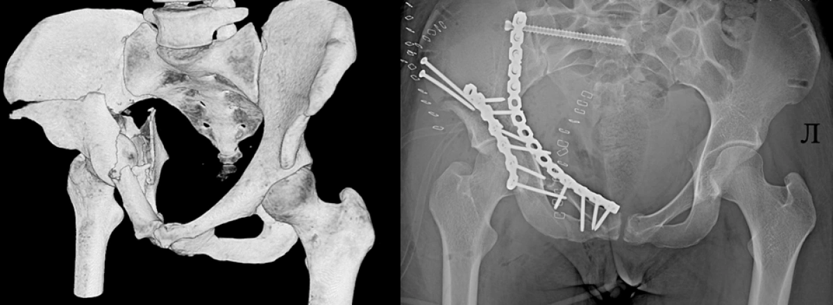 Молодая ярославна попала в реанимацию после катания на &laquo;ватрушке&raquo;