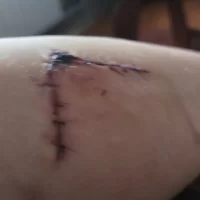 &laquo;Глубокая рана&raquo;: под Ярославлем хозяйская собака вцепилась в ногу ребенку