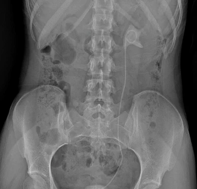 Ярославские врачи помогли девушке, забывшей удалить стент из мочевого пузыря